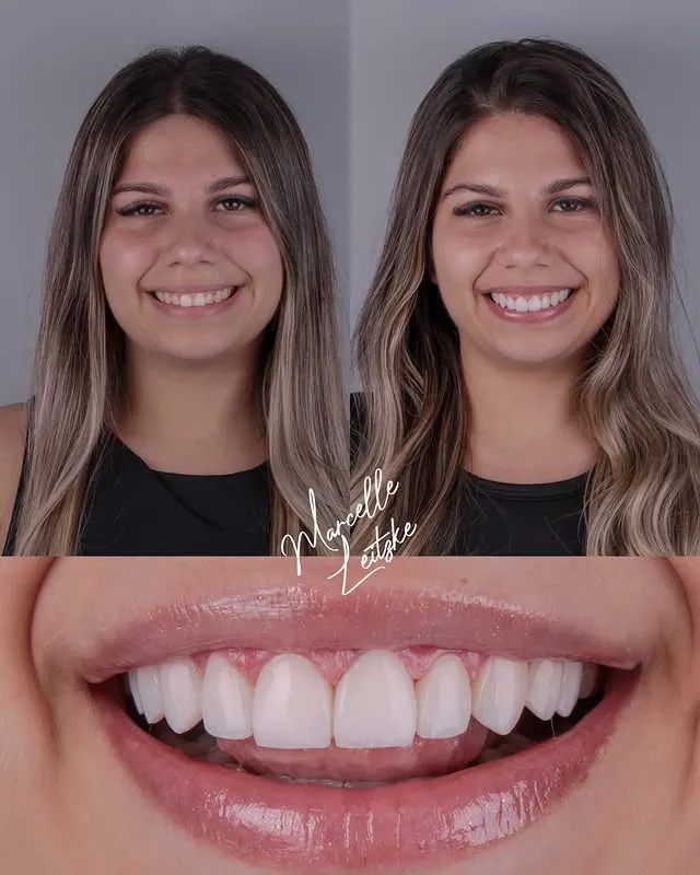 Antes e depois — Naturalidade