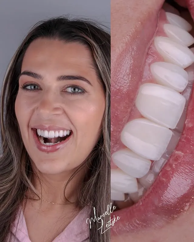 Antes e depois — Resultado Final