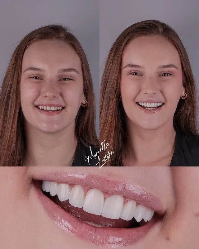 Antes e depois — Lentes em Resina